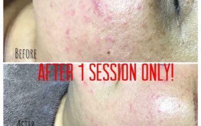 What Is Microdermabrasion?