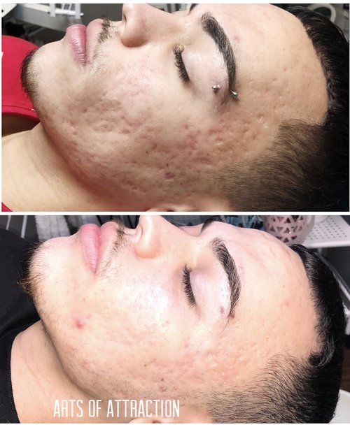 Microneedling at Arts of Attraction in St. Petersburg, FL (photo 4)