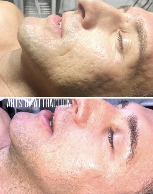 Facials & Skin Rejuvenation at Arts of Attraction in St. Petersburg, FL (photo 3)
